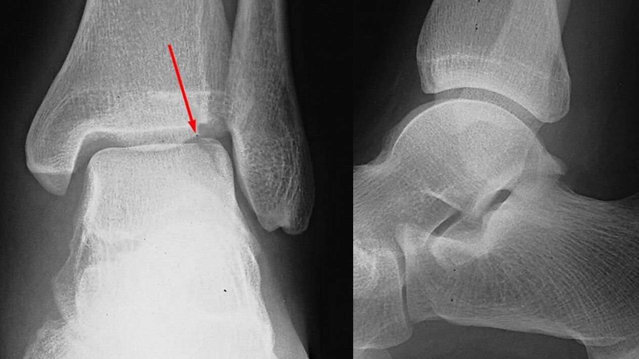 x-ray of the ankle