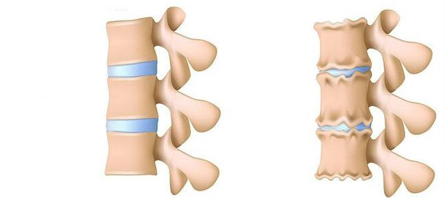 Osteochondrosis on the inside