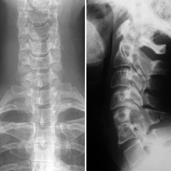 X -ray on the cervical spine
