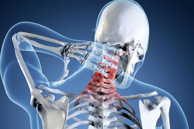 Osteochondrosis of the cervical region