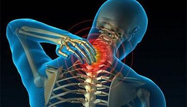 Symptoms of osteochondrosis of the cervical spine