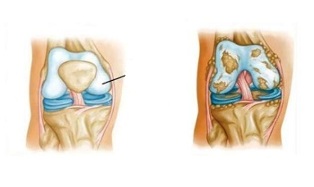 pathological changes in osteoarthritis of the knee