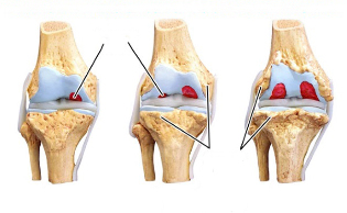 stages of osteoarthritis of the knee