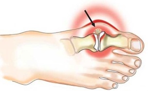 Inflammation of the joint between the thumb and foot in arthritis