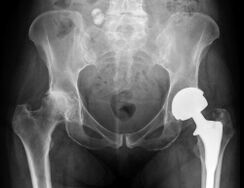 diagnosis of osteoarthritis of the hip