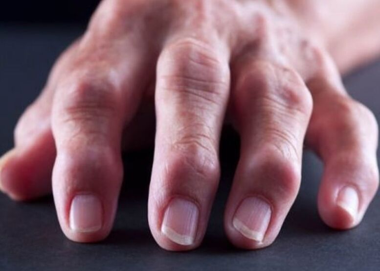 rheumatoid arthritis as a cause of pain in the joints of the fingers