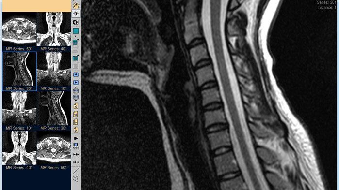 MRI of the cervical spine is the best method for diagnosing neck pain