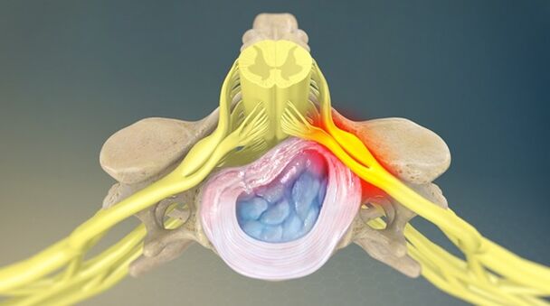 radicular syndrome as a cause of back pain