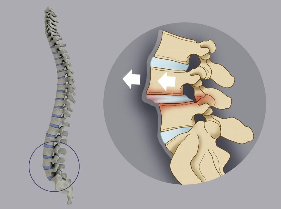 vertebral displacement as a cause of back pain